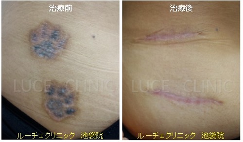 切除によるタトゥー除去