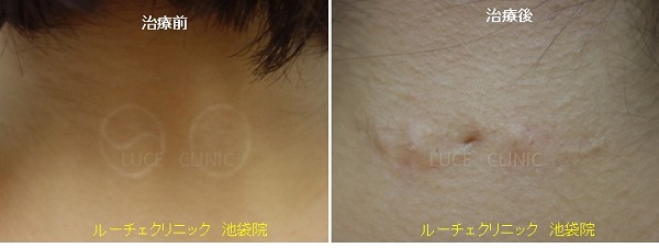 切除による首のタトゥー除去