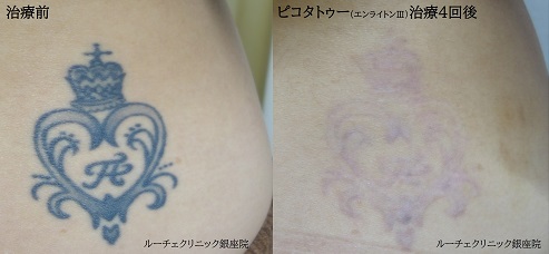 タトゥー除去、ピコレーザー、4回、腕、黒