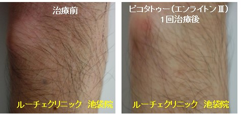 タトゥー除去ピコレーザー、1回、腕、黒、とれた