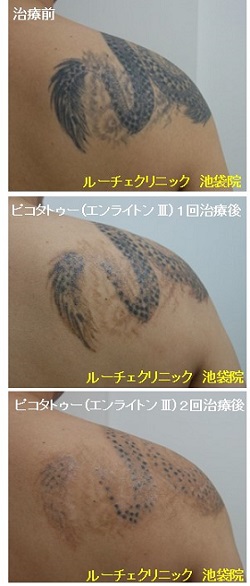 タトゥー除去ピコレーザー、2回、背中、黒、経過