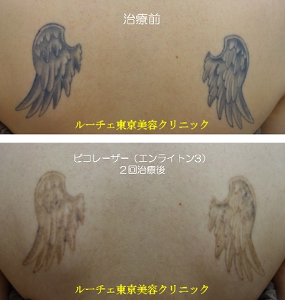 背中のタトゥーにピコレーザーを当てました＿