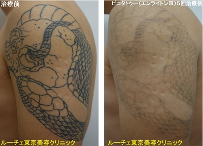 腕のスジボリタトゥー＿