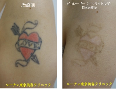 肩のカラータトゥーを薄くしています＿