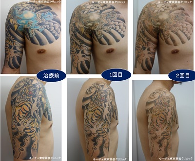 広範囲、腕から肩、胸のカラータトゥー経過３回分写真　青黄色黒オレンジ4色、経過
