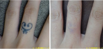 指のタトゥーが消えてきました。とれた