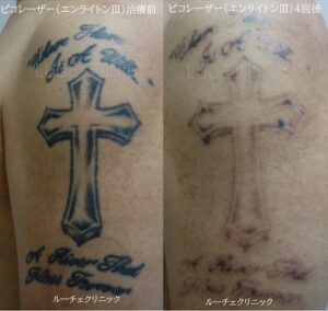 タトゥー除去ピコレーザー4回、腕、黒の症例ビフォーアフター