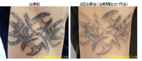 腕の黒タトゥー