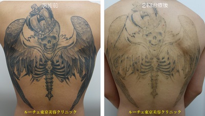 背中広範囲黒タトゥー2回