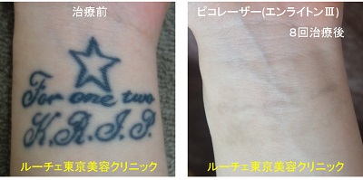 手首の黒一色タトゥーがピコレーザーでとれました