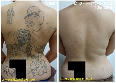 タトゥー除去ピコレーザー、13回、背中、黒、とれた