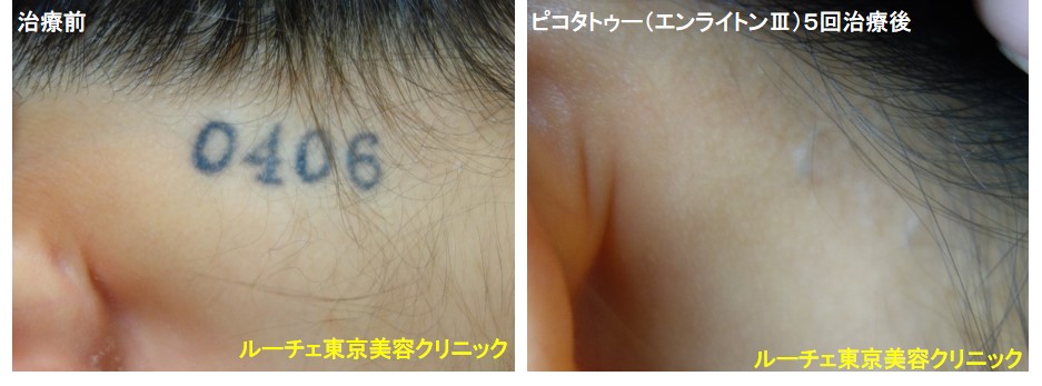 タトゥー除去ピコレーザー、項、5回、黒、とれた
