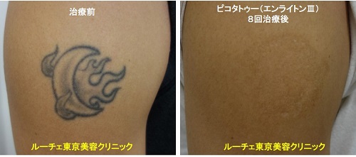 タトゥー除去ピコレーザー、腕、8回、黒、とれた