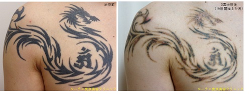 エンライトンⅢ　NEWピコレーザー　濃く盛り上がっている黒