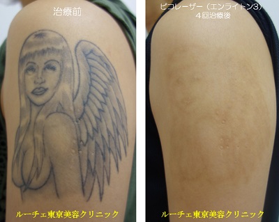 ピコレーザー（エンライトンⅢ）で肩～腕のタトゥーをとります＿