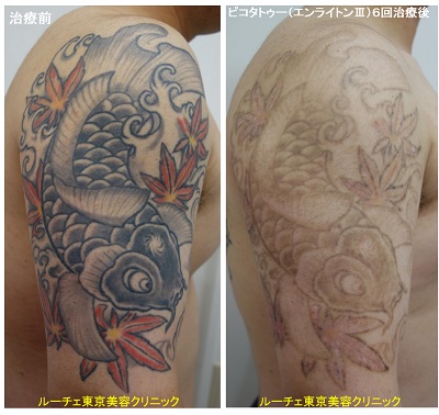 カラフルな肩のタトゥーにピコレーザーを当てました＿