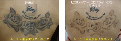 1回の治療でもタトゥーが薄くなりました＿