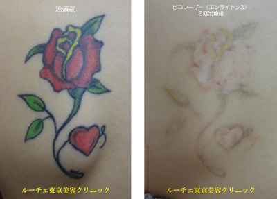 背中のカラータトゥーにピコレーザーを当てています＿