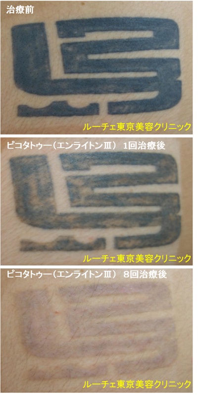 腕の濃く・盛り上がったタトゥーが薄くなっていく＿経過写真