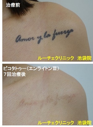 タトゥー除去ピコレーザー、胸、７回、黒、とれた