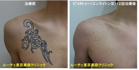 タトゥー除去ピコレーザー、胸、12回、黒、とれた
