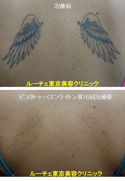 タトゥー除去ピコレーザー、背中、5回、黒、オレンジ、とれた