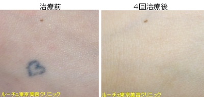 手の甲タトゥー除去、とれた