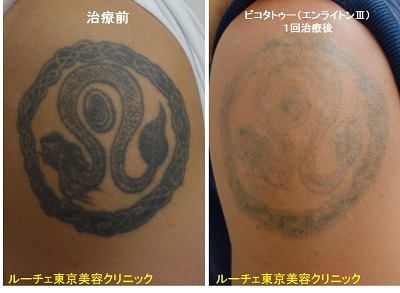 腕の黒一色タトゥーを１回のピコレーザーで薄くします＿