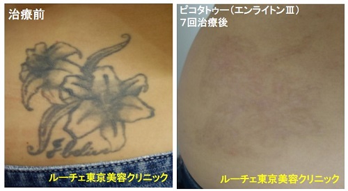 タトゥー除去ピコレーザー、6回、腕、黒