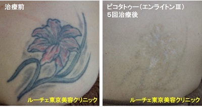 タトゥー除去ピコレーザー、胸～腕、黒、水色、緑