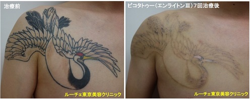 タトゥー除去ピコレーザー、4回、胸、黒、紫