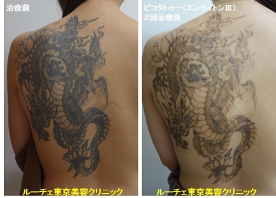 タトゥー除去ピコレーザー、4回、腕、黒