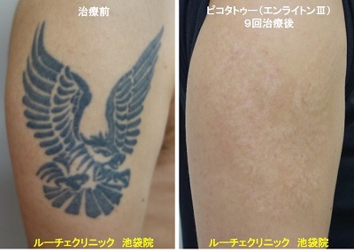 タトゥー除去ピコレーザー、腕、9回、黒、とれた