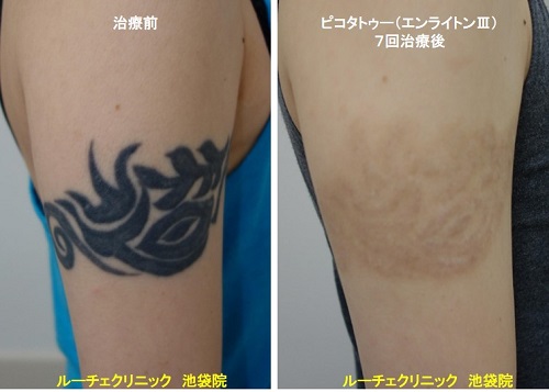 タトゥー除去ピコレーザー、手首、8回、黒