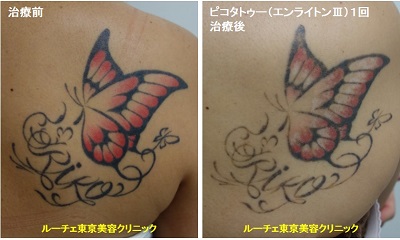 タトゥー除去ピコレーザー、1回、背中、黒、赤、ちょう