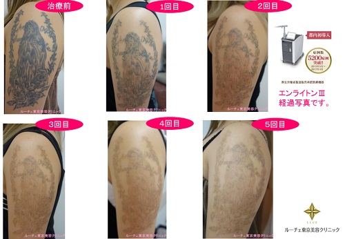 黒のグラデーションのあるタトゥー。濃い部分から薄いところまで、経過