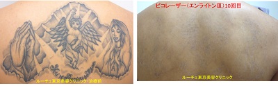背中上半分の広いタトゥーをピコレーザーで消しています＿