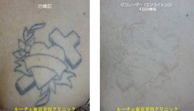 胸の黒一色タトゥーのピコレーザー＿