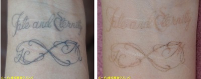 手首のタトゥー除去