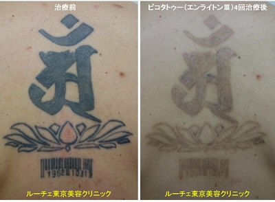 背中の盛り上がりのあるタトゥーにピコレーザー治療をしています＿