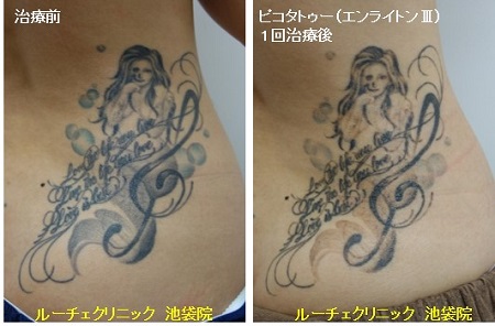 タトゥー除去ピコレーザー、2回、腕、赤、黄色