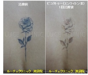 タトゥー除去ピコレーザー、1回、背中、黒