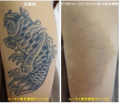 二の腕の黒一色タトゥーにピコレーザーを当てています＿