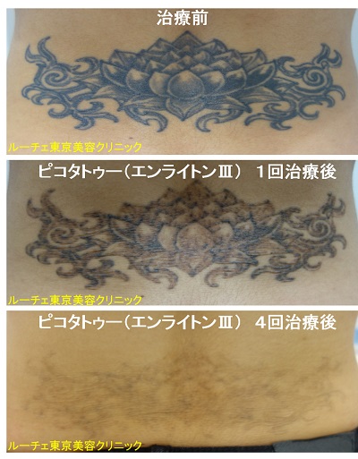 腰のタトゥーが薄くなっていく経過写真＿
