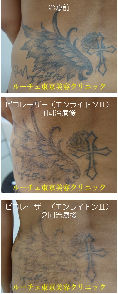 腰のタトゥー黒2回、経過