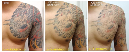 腕～胸の濃い広範囲タトゥー