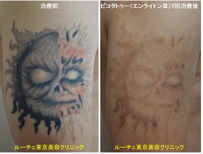 赤と黒の腕のタトゥーが薄くなりました＿