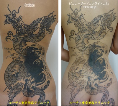 背中の広範囲タトゥーを薄くしています＿