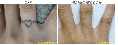 指のタトゥー除去、とれた