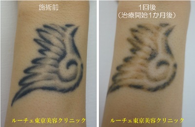 羽のタトゥー除去、手首